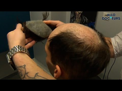 CALVITIE : une solution MIRACLE ?